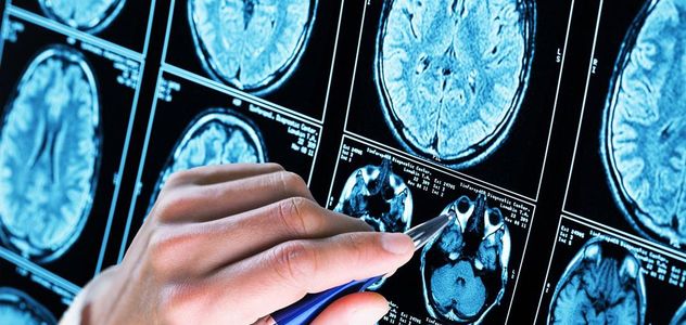 Iss, scoperto meccanismo chiave Alzheimer, speranza per diagnosi e cure