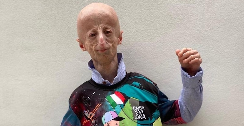 Muore a 28 anni Sammy Basso, il più anziano malato di Progeria